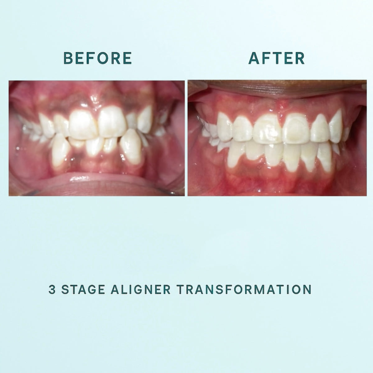 Echelon 3 Stage Orthodontic Aligner